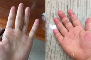 狗鼻子脱皮的原因及预防措施（狗鼻子脱皮的常见原因及如何保护它们）