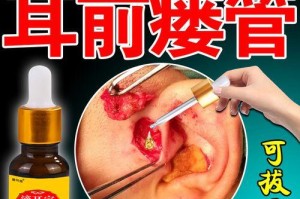 祛除耳垢利器（以什么药水能让耳朵脏东西流出来）