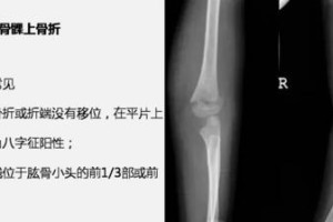 狗狗前肘关节骨折的症状、治疗和预防（——前肘骨折）