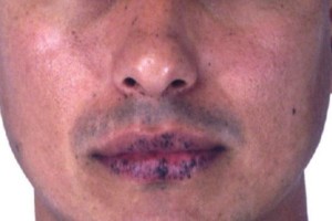 眼皮上长息肉的原因及治疗方法（眼部息肉的症状、影响和预防措施）